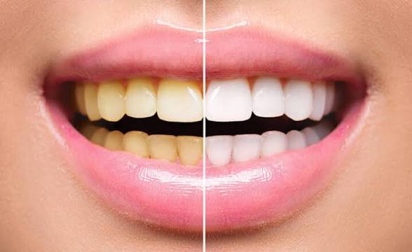 How to Whiten Your Teeth Without Damaging Enamel