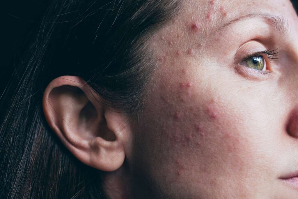 How to Recognize Hormonal Imbalance Symptoms